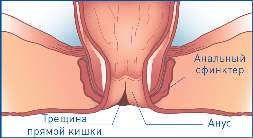 Порно Трахают В Прямую Кишку