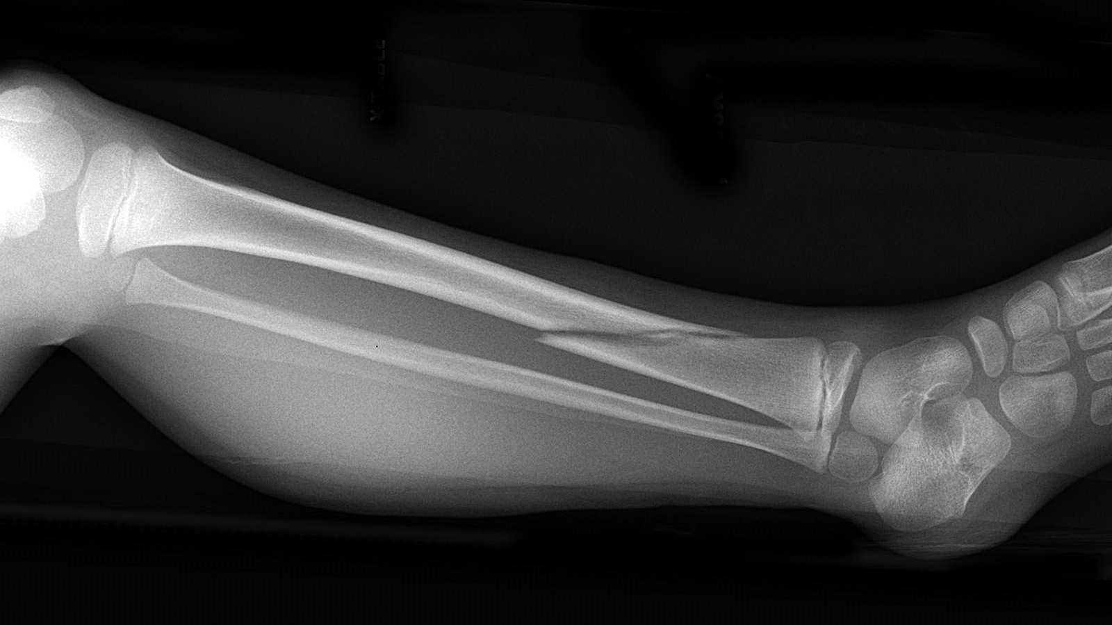 Перелом берцовой кости рентген
